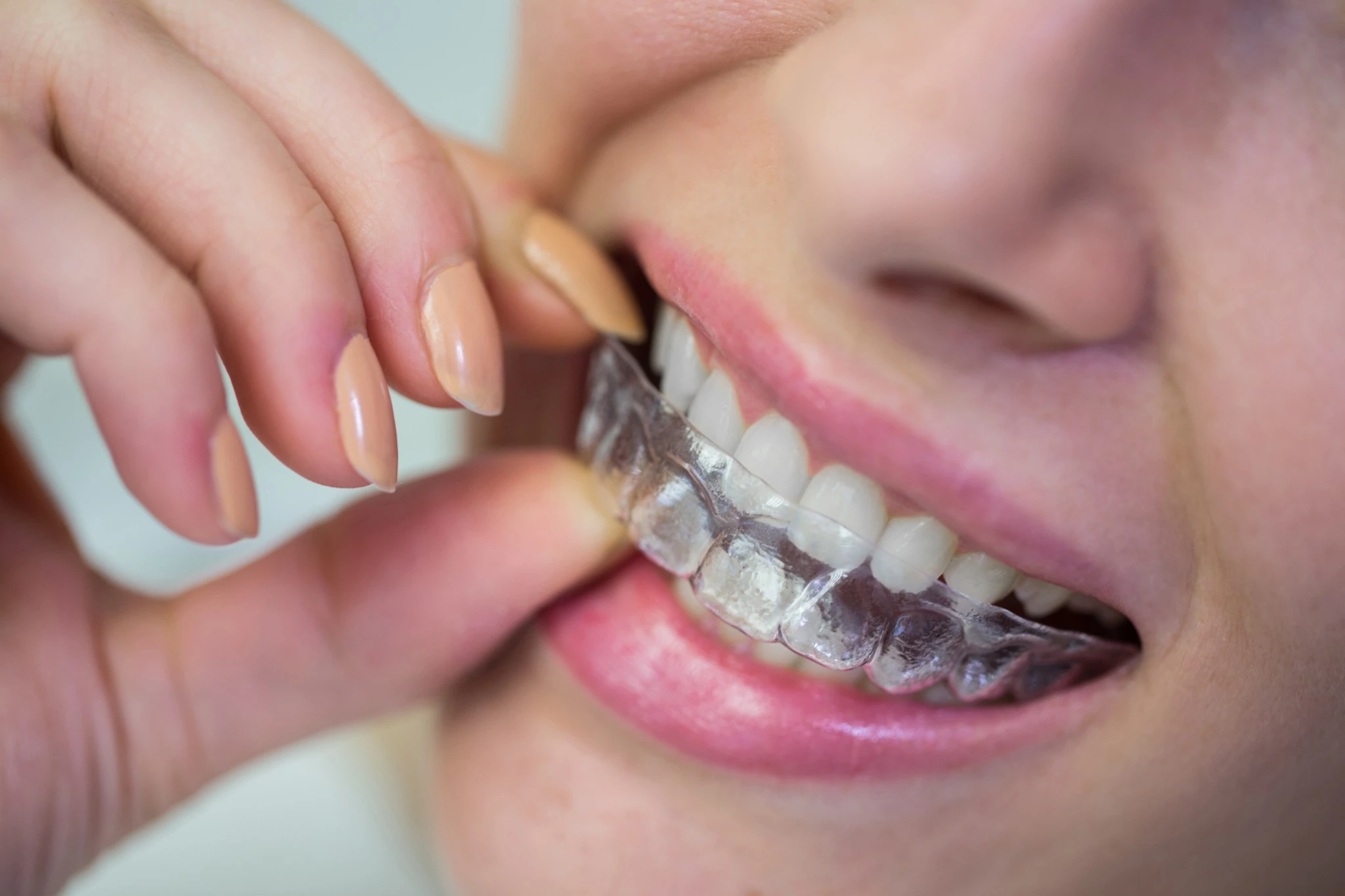 Aligners and Braces