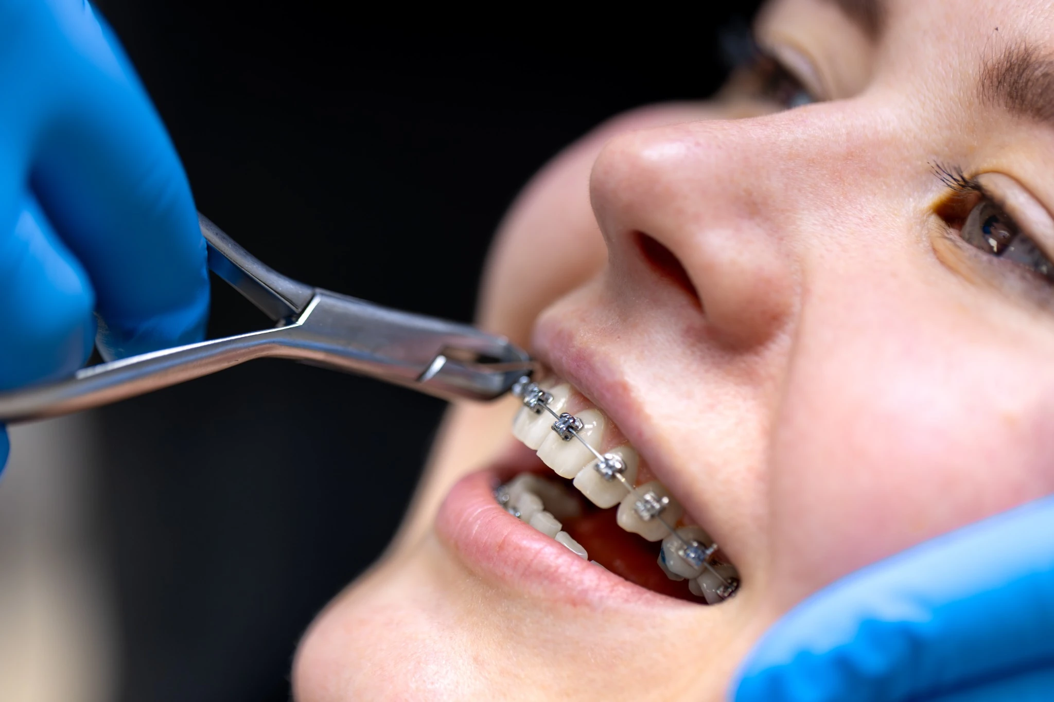 Orthodontics Braces